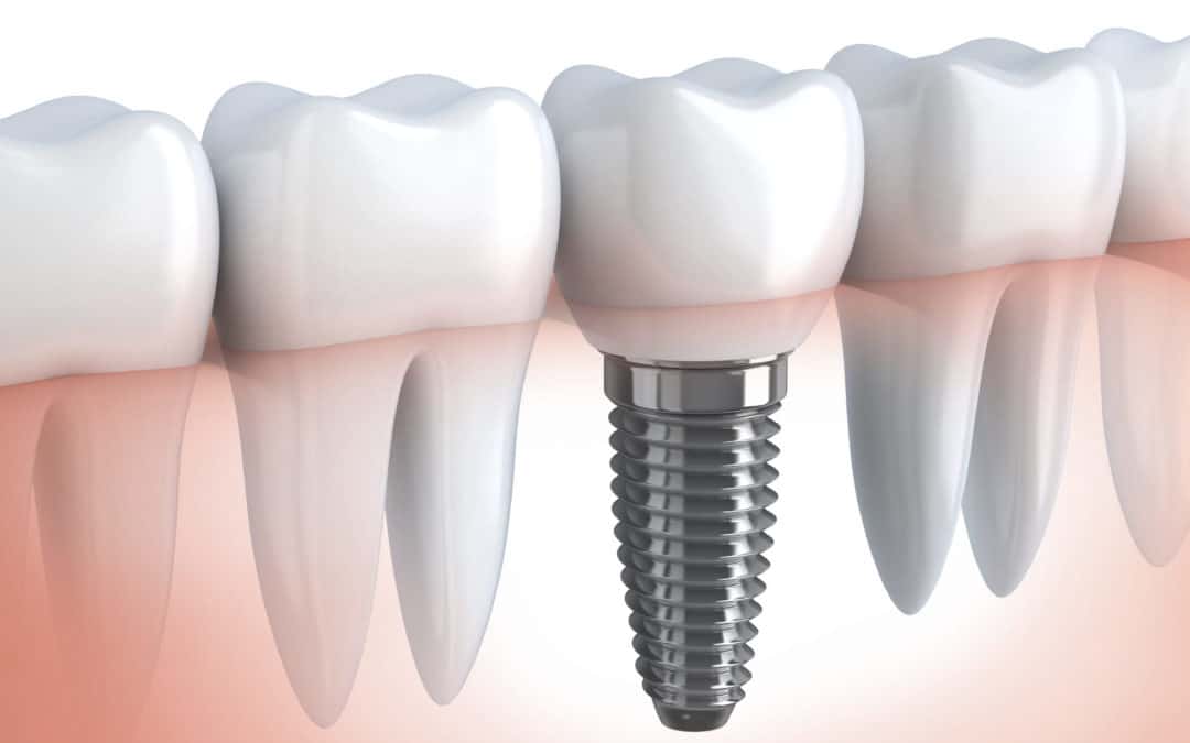 9 Reasons Why Titanium Dental Implants Are The Best