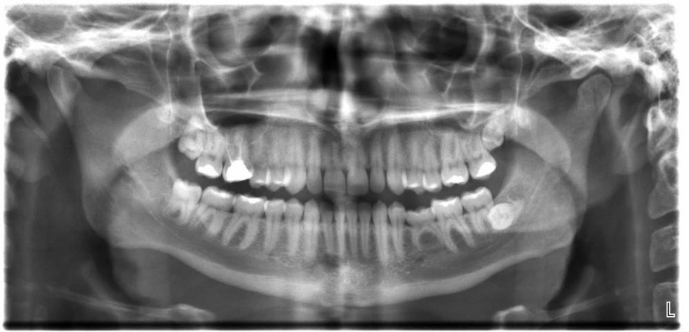 digital x-ray toronto - downtown dentistry