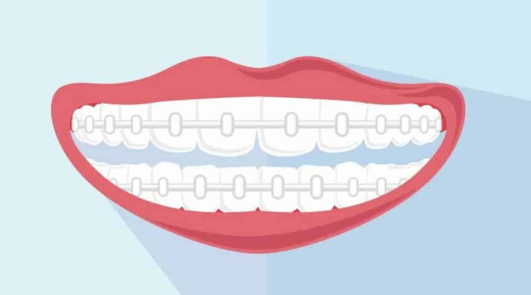 Top 3 Reasons Why Ceramic Braces Are The Best Orthodontic Option