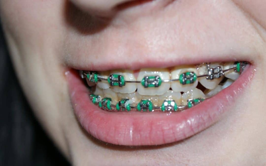Procedure Cost And Advantages Of Accelerated Orthodontics In Toronto