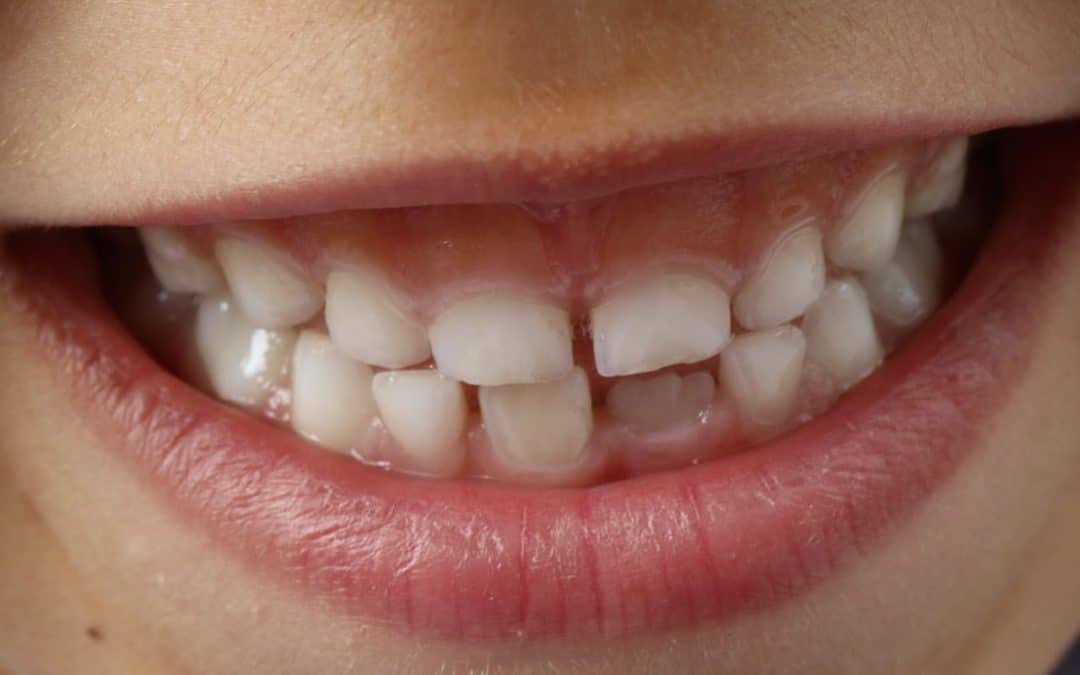 Are You Looking For Treatment Of Gapped Teeth In Toronto