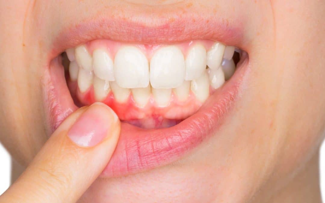 Gum Graft Surgery Recovery Tips