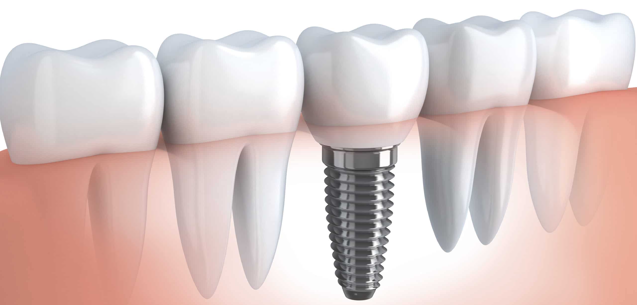 dental implant toronto by downtown dentistry
