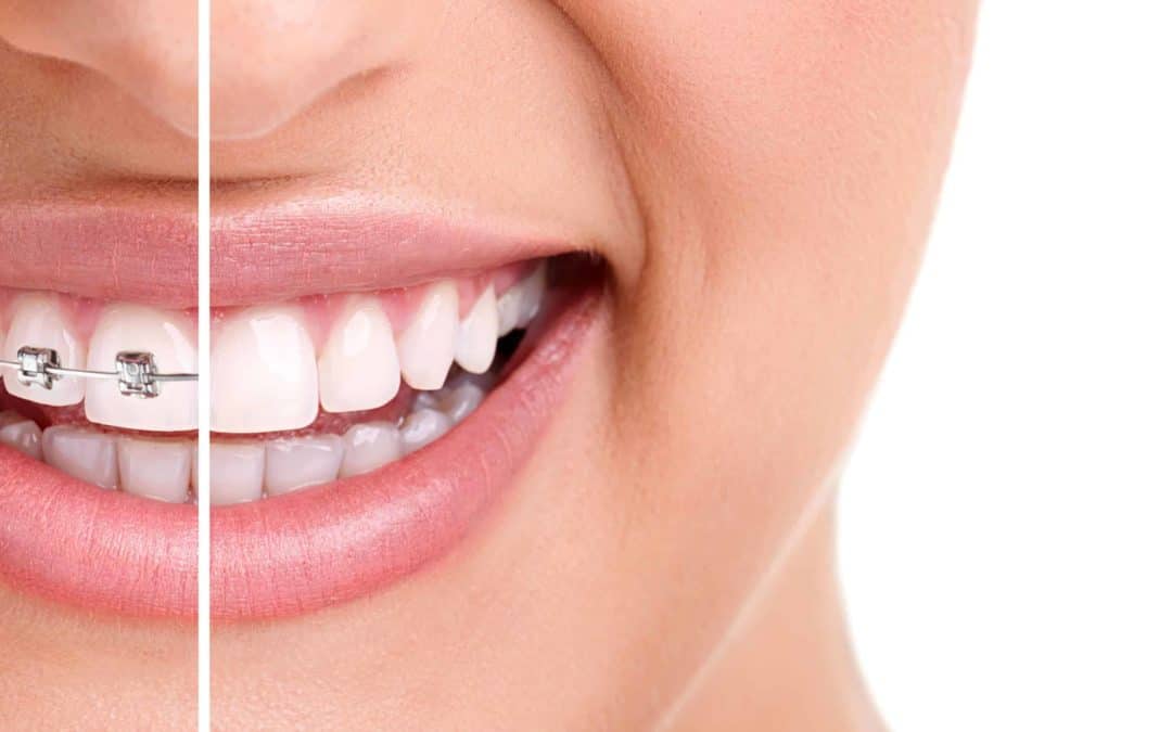 What Is The Procedure For Invisalign In Downtown Toronto
