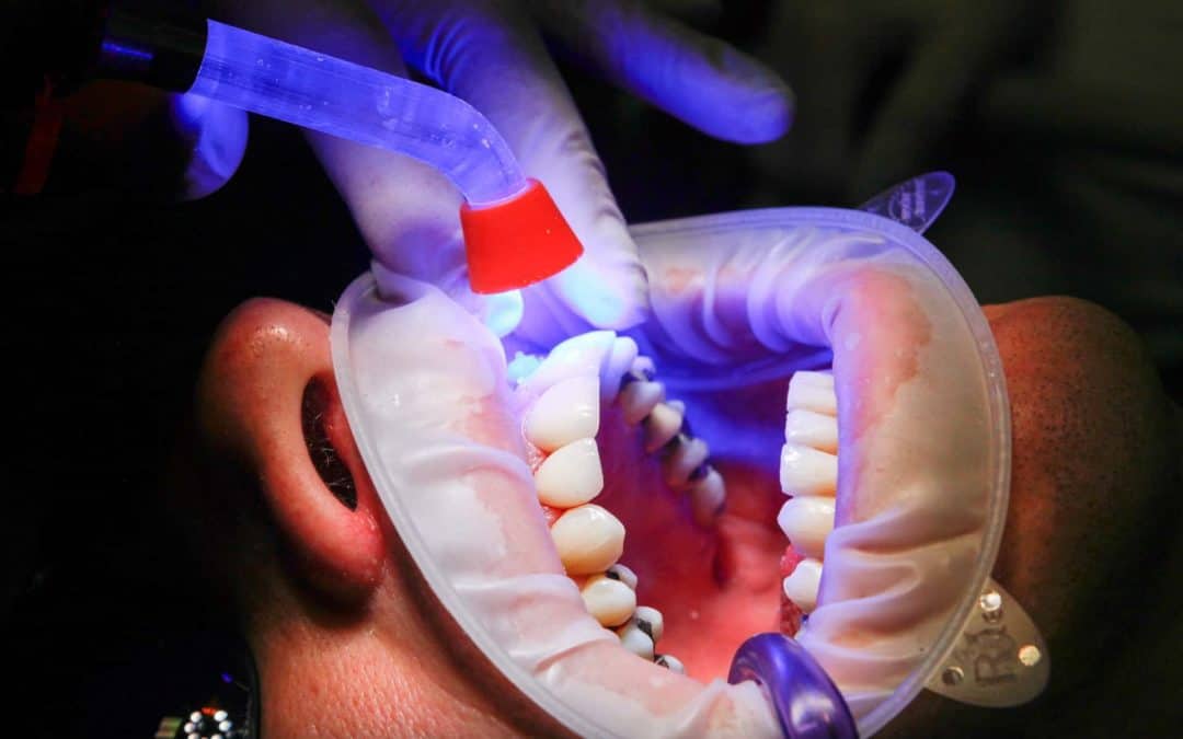 Laser Dental Treatment In Toronto