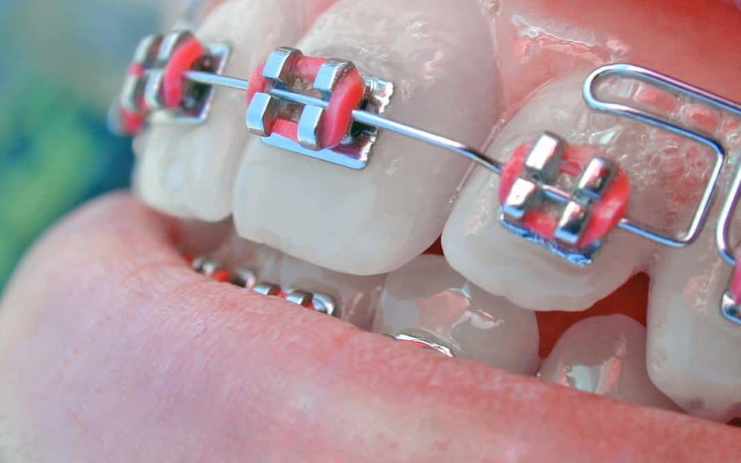 Which Is The Right Type Of Conventional Braces In Toronto