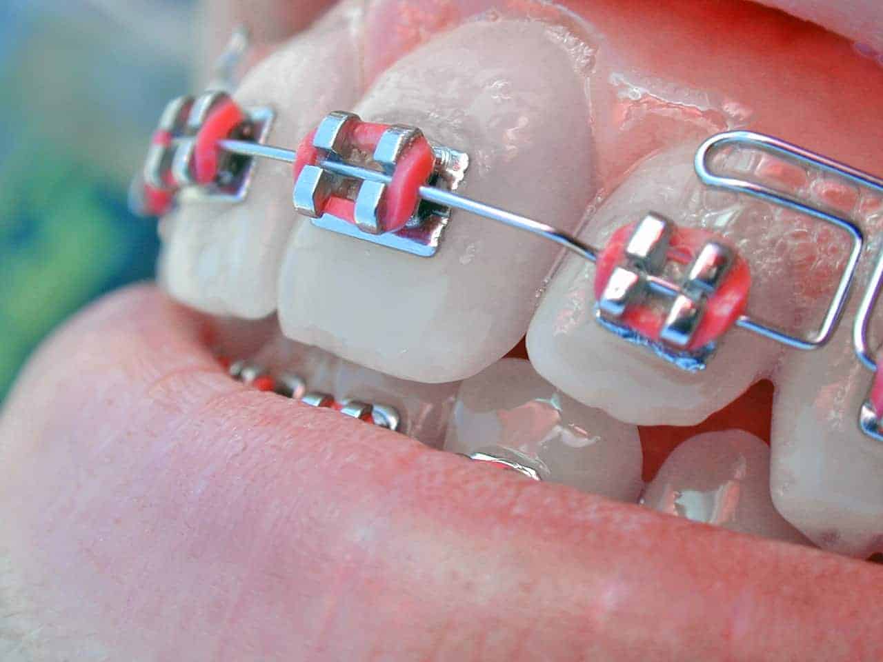 conventional braces by Toronto Dentists - downtown dentistry