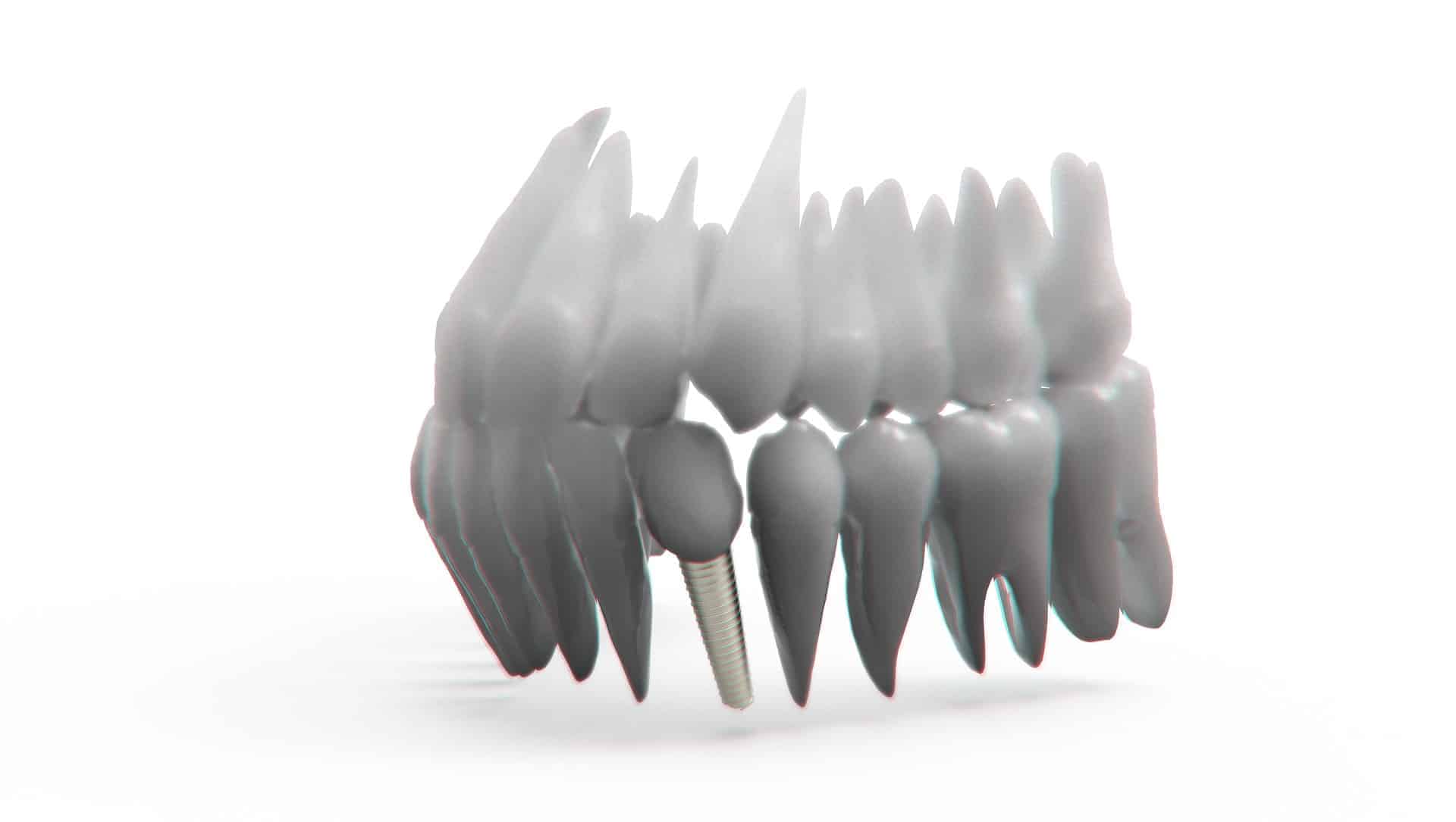 dental implants by Toronto Dentists - downtown dentistry