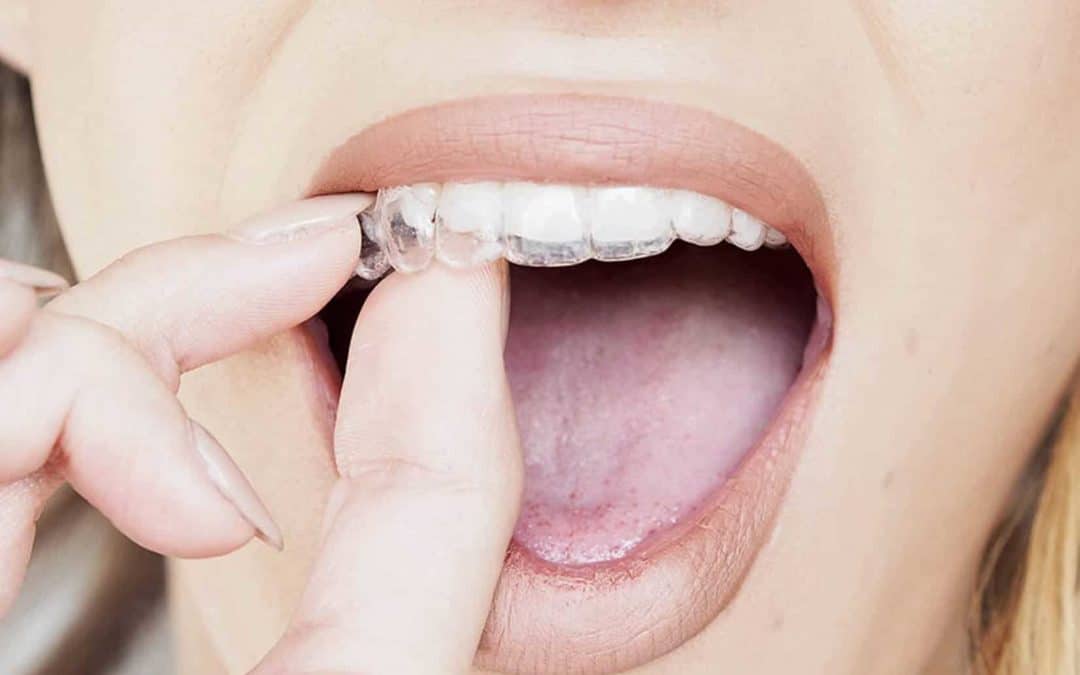 The Pros And Cons Of Invisalign Treatment In Toronto