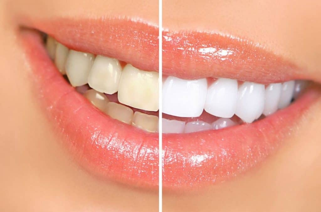 How Fast Is A Teeth Whitening Procedure