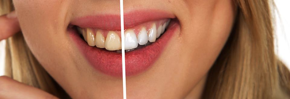All About Porcelaine Veneers