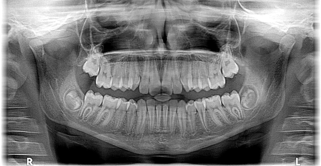 dental x-ray toronto by downtown dentistry