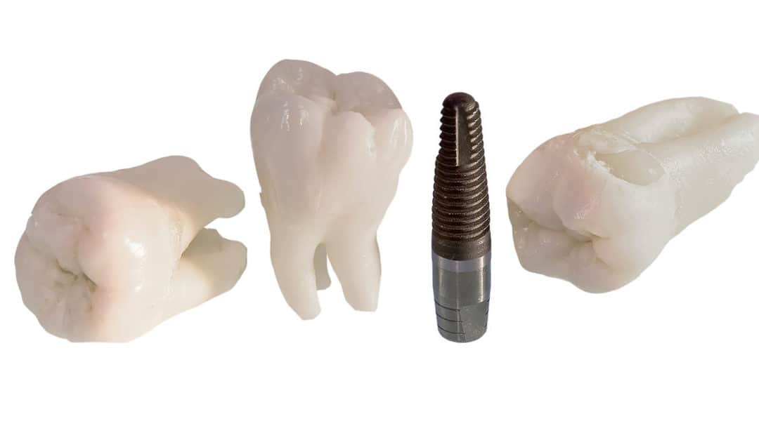 5 Reasons Why Dental Implants Are The Best Restorations