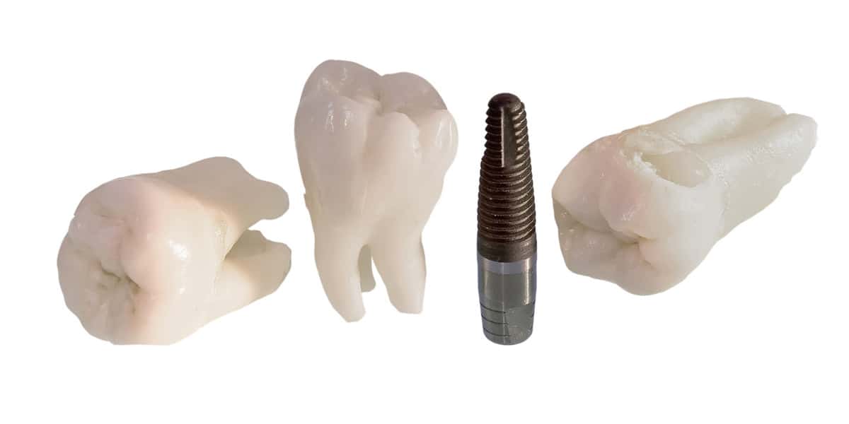 dental implants by downtown dentistry