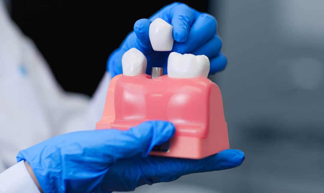 The Different Stages Of Dental Implant Surgery