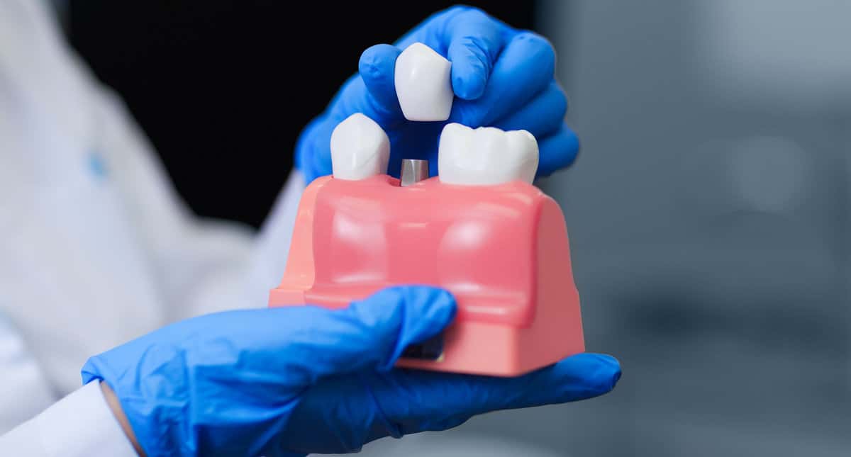 dental implants model by downtown dentistry