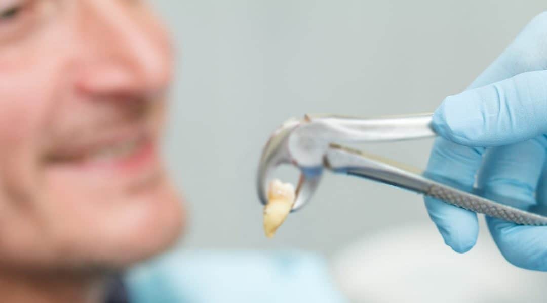 Wisdom Tooth Extraction: The Consequences Of Saying No To It
