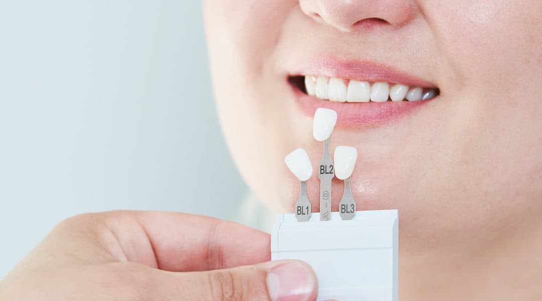 Lumineers Teeth: The Innovative Twist To Dental Veneers