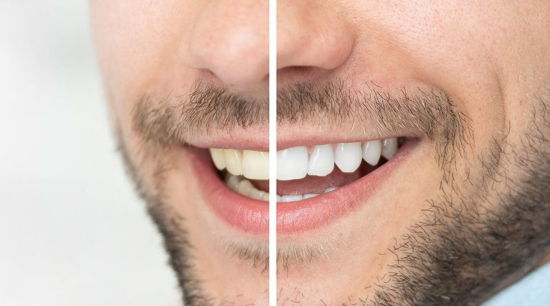 Instant Teeth Whitening – The Secret To Whiter And Brighter Smile