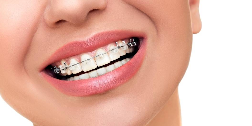 Ceramic Dental Braces: The Benefits And Downsides