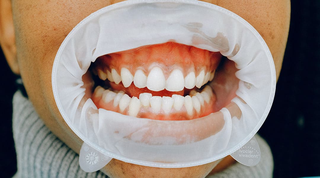 Are Your Gums Trying To Tell You Something?