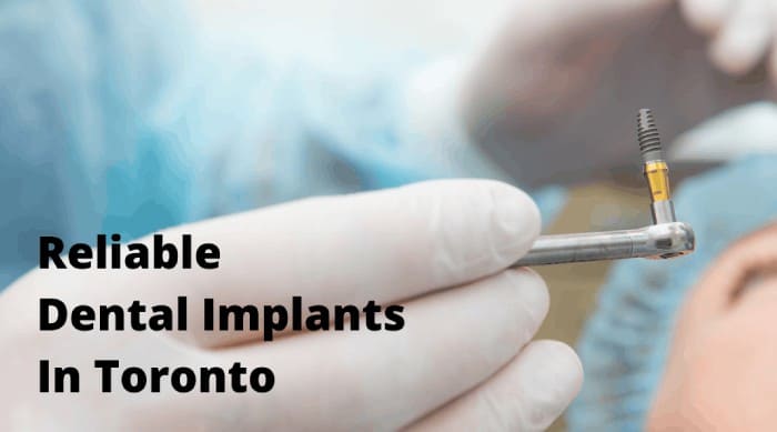 If You Have Missing Teeth, Consider Dental Implants