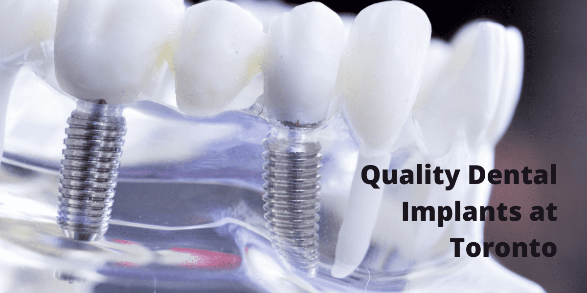Quality Dental Implants at Toronto