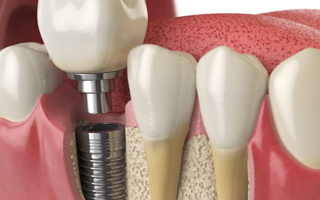 8 Reasons Why Titanium Dental Implants Are Great Options