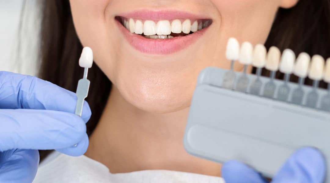 Important Things You Need To Know Before Getting Veneers