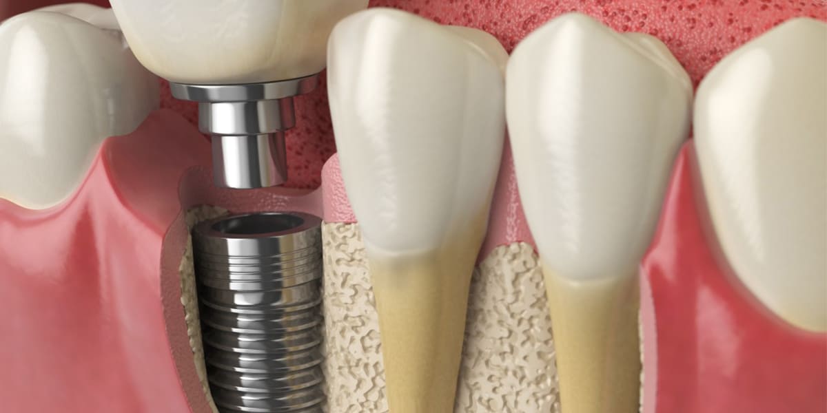 Titanium dental implants with crown