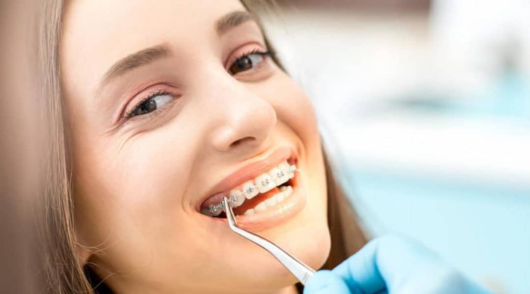 5 Reasons Why You Should Choose Porcelain Braces In Toronto