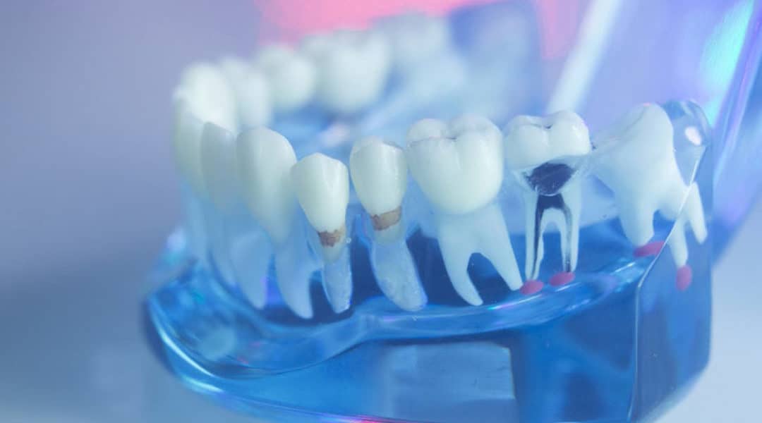 Warning Signs That Might Need A Root Canal Therapy