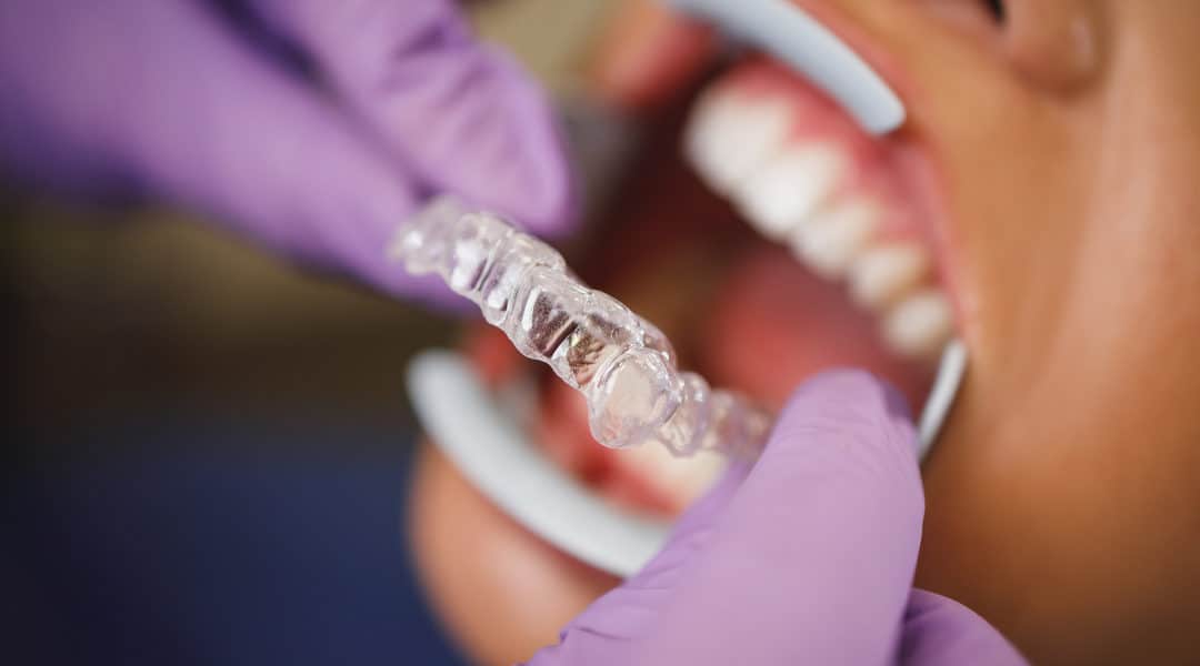 Teeth Care With Invisalign: Downtown Toronto Dentist