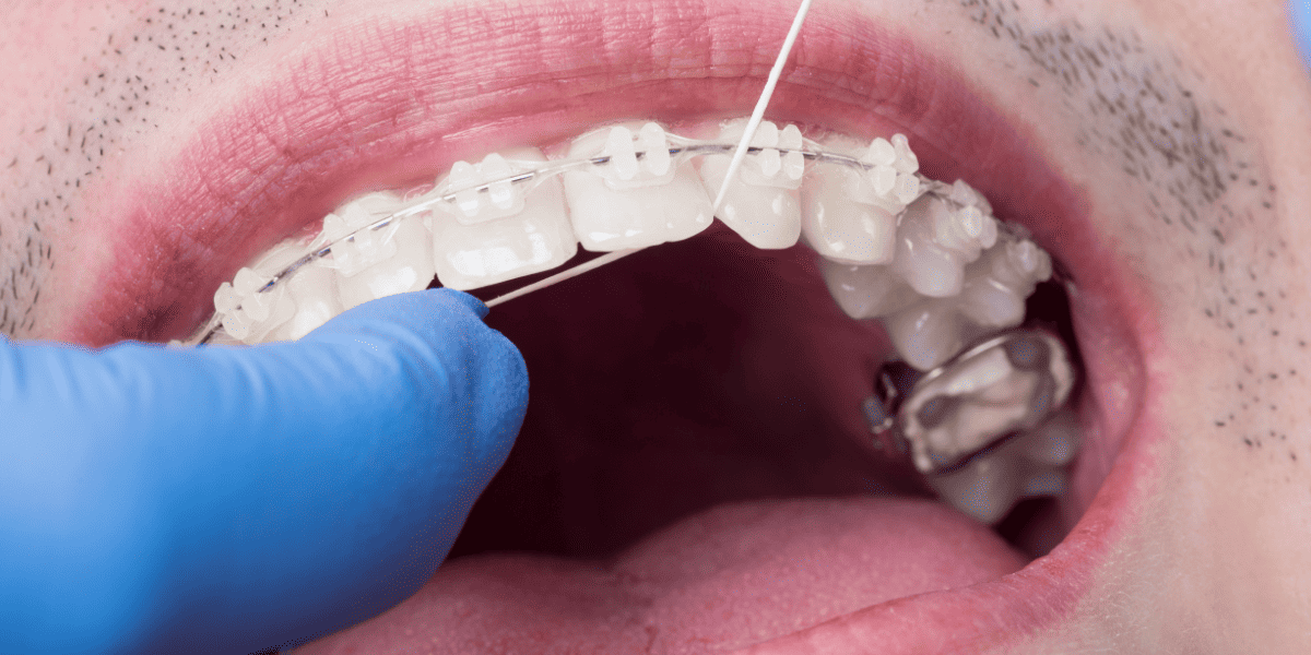 Dental flossing of teeth with braces in Toronto