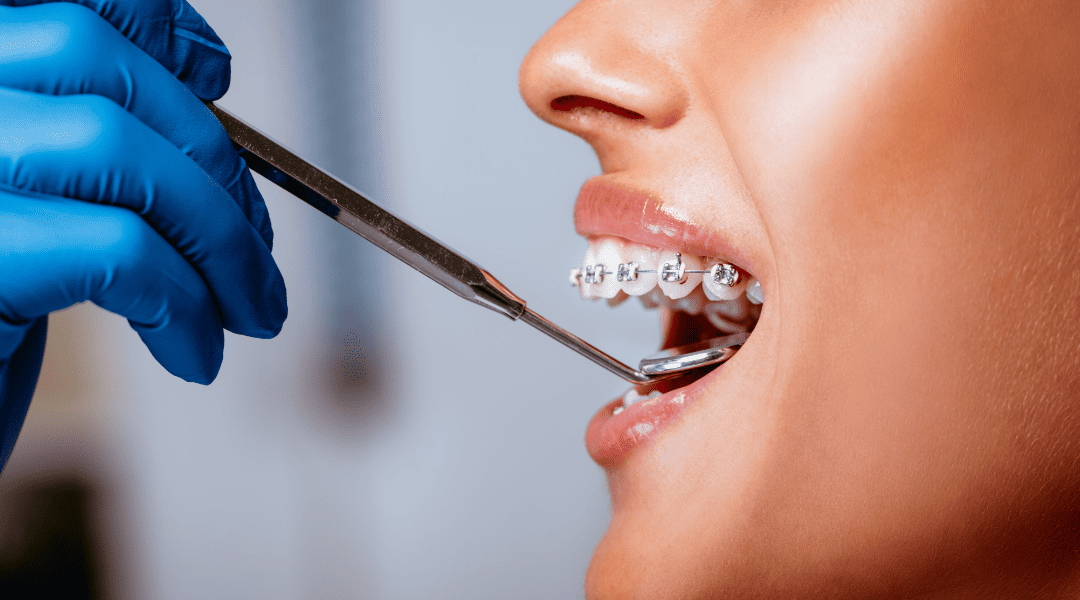 Sparkling Smiles: How Do Dentists Clean Teeth With Braces?